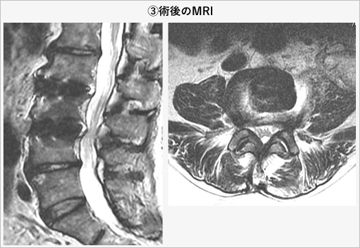 3)術後のMRI