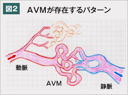 図2　AVMが存在するパターン