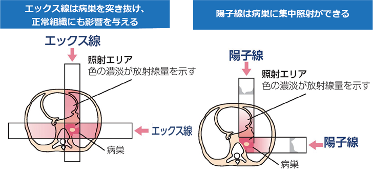乳がんに対する陽子線治療はどの程度効果がありますか?